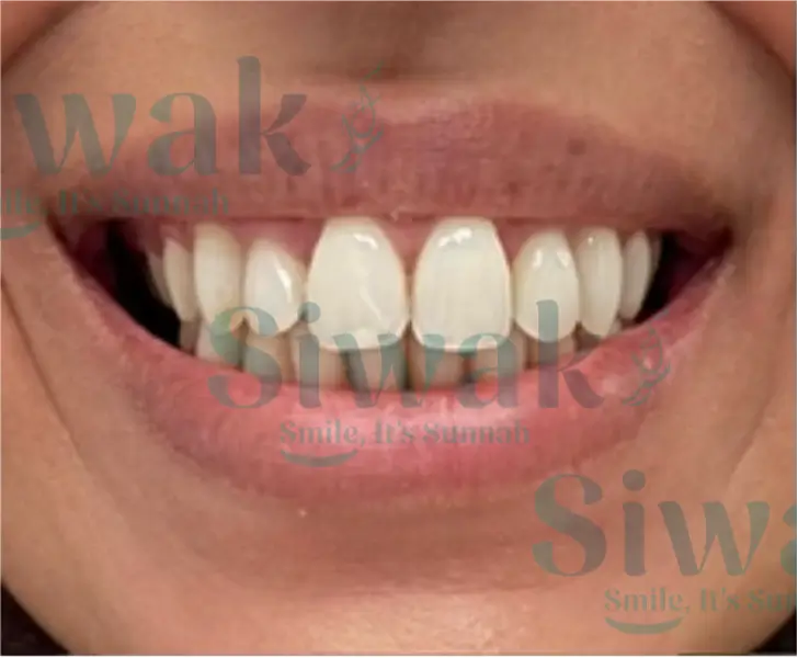 Sourire avec dents blanches éclatantes après blanchiment naturel au Siwak, résultat visible du bâtonnet miswak, transformation dentaire Siwak Smile It's Sunnah