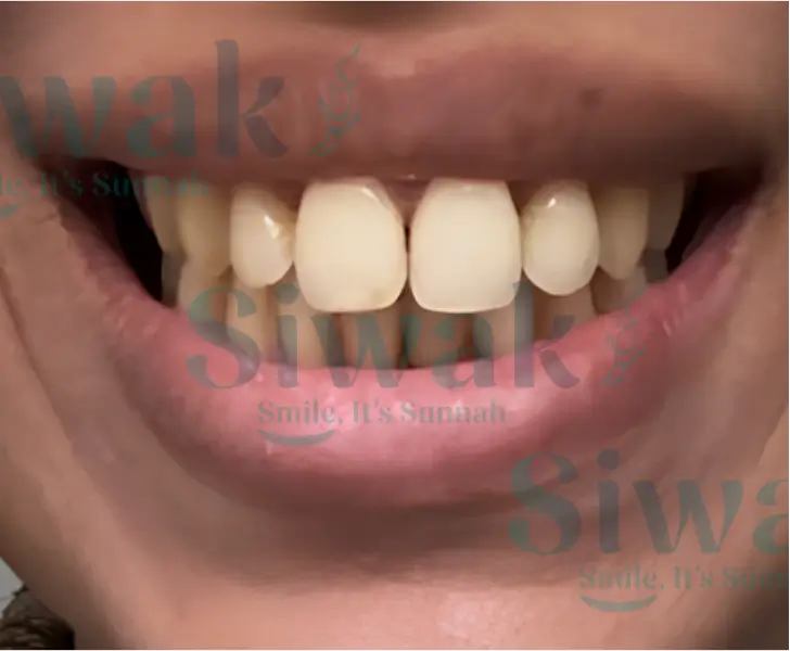 Sourire avec dents tachées et jaunies avant blanchiment naturel au Siwak, bâtonnet miswak pour hygiène bucco-dentaire, produit Siwak Smile It's Sunnah