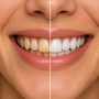 Jaunissement des dents : la solution Siwak
