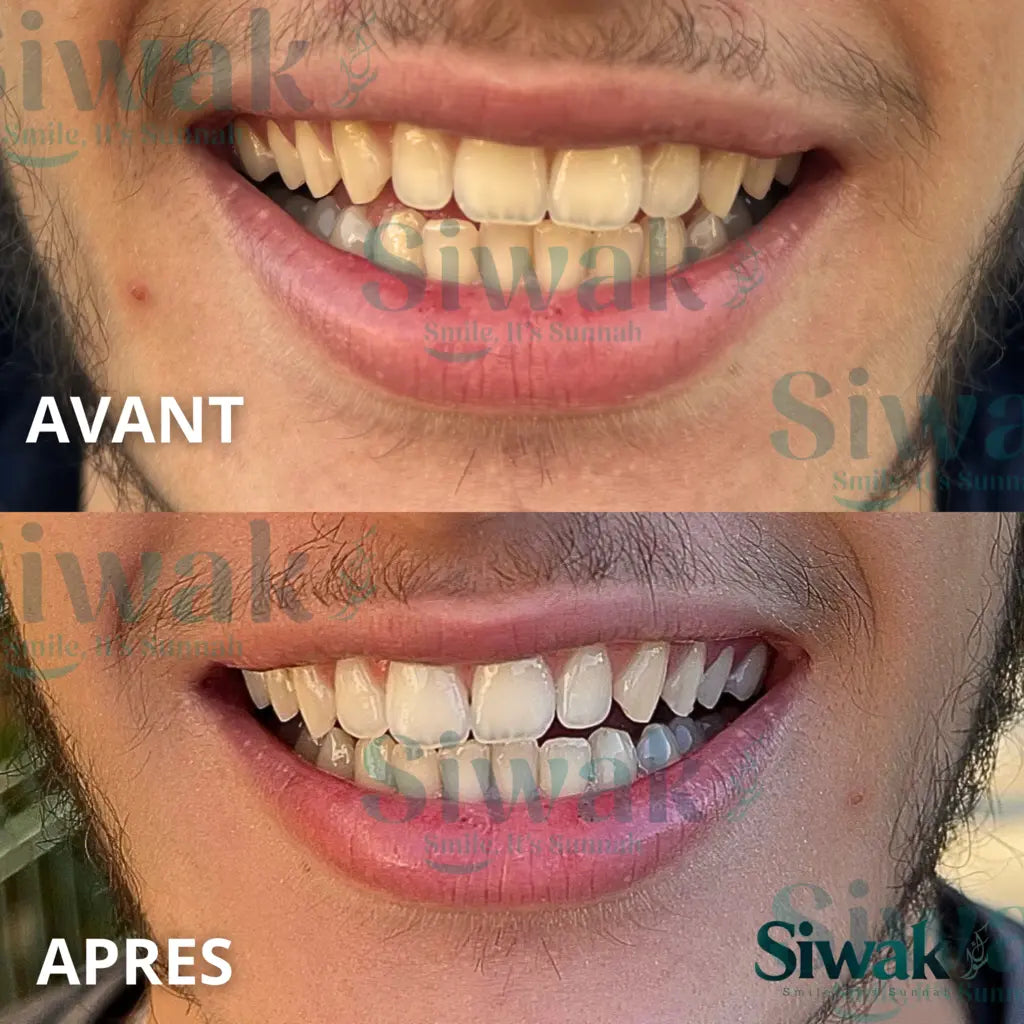 Pack découverte Blanchiment 28