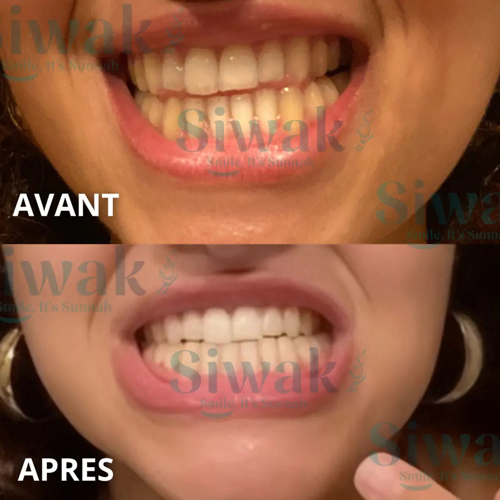 Kit blanchiment 28 + Colis assuré tous risques OFFERT - SiwakSmile