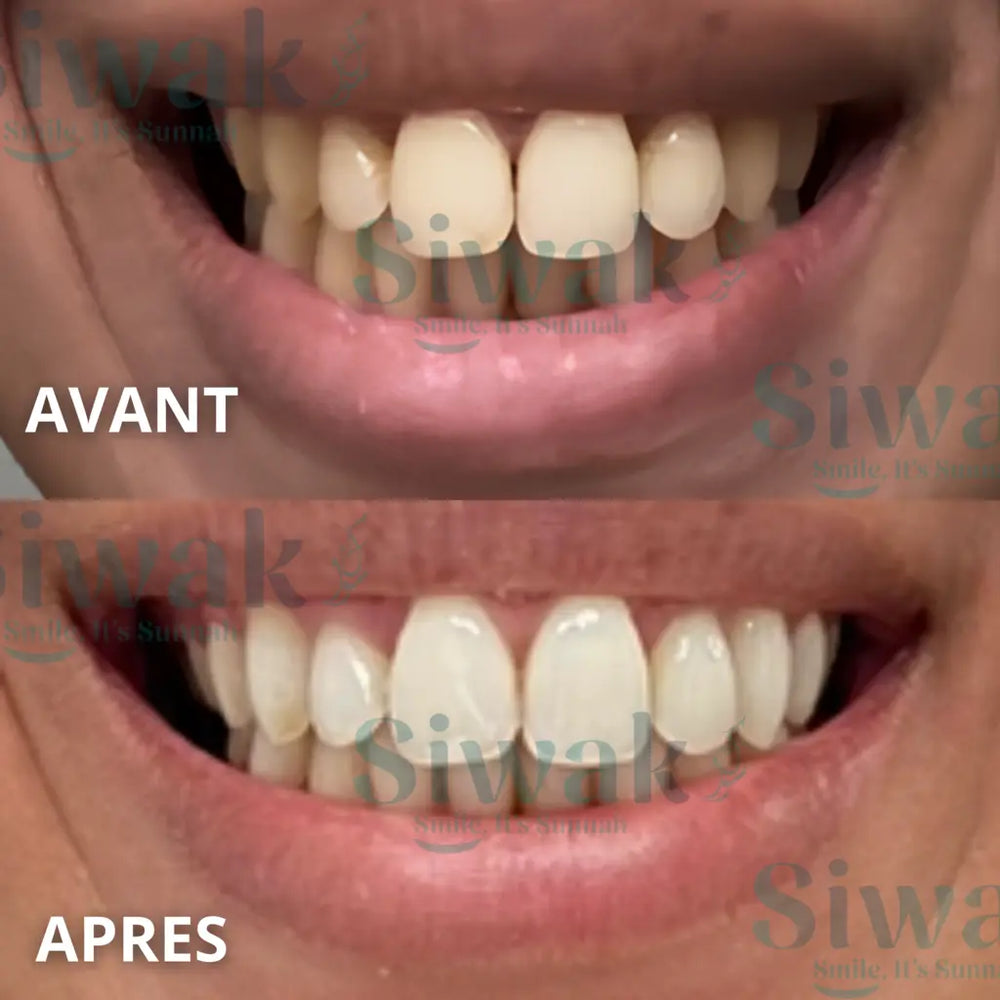 Avant et après d’un client SiwakSmile