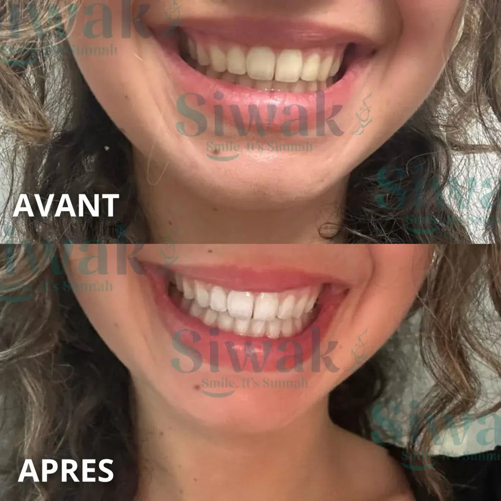 Comparatif avant et après d’une cliente SiwakSmile