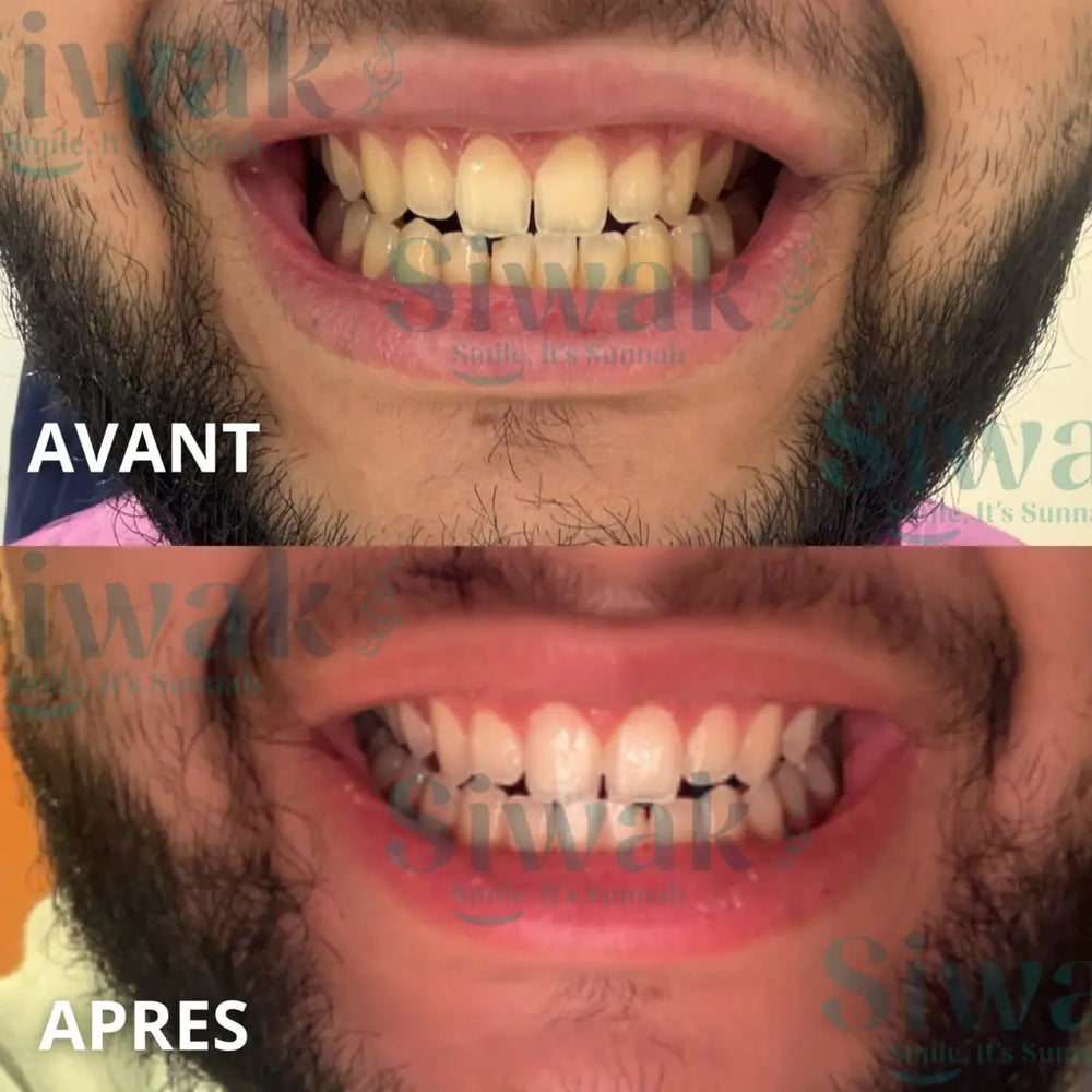Avant et après d’Adam pendant son challenge SiwakSmile