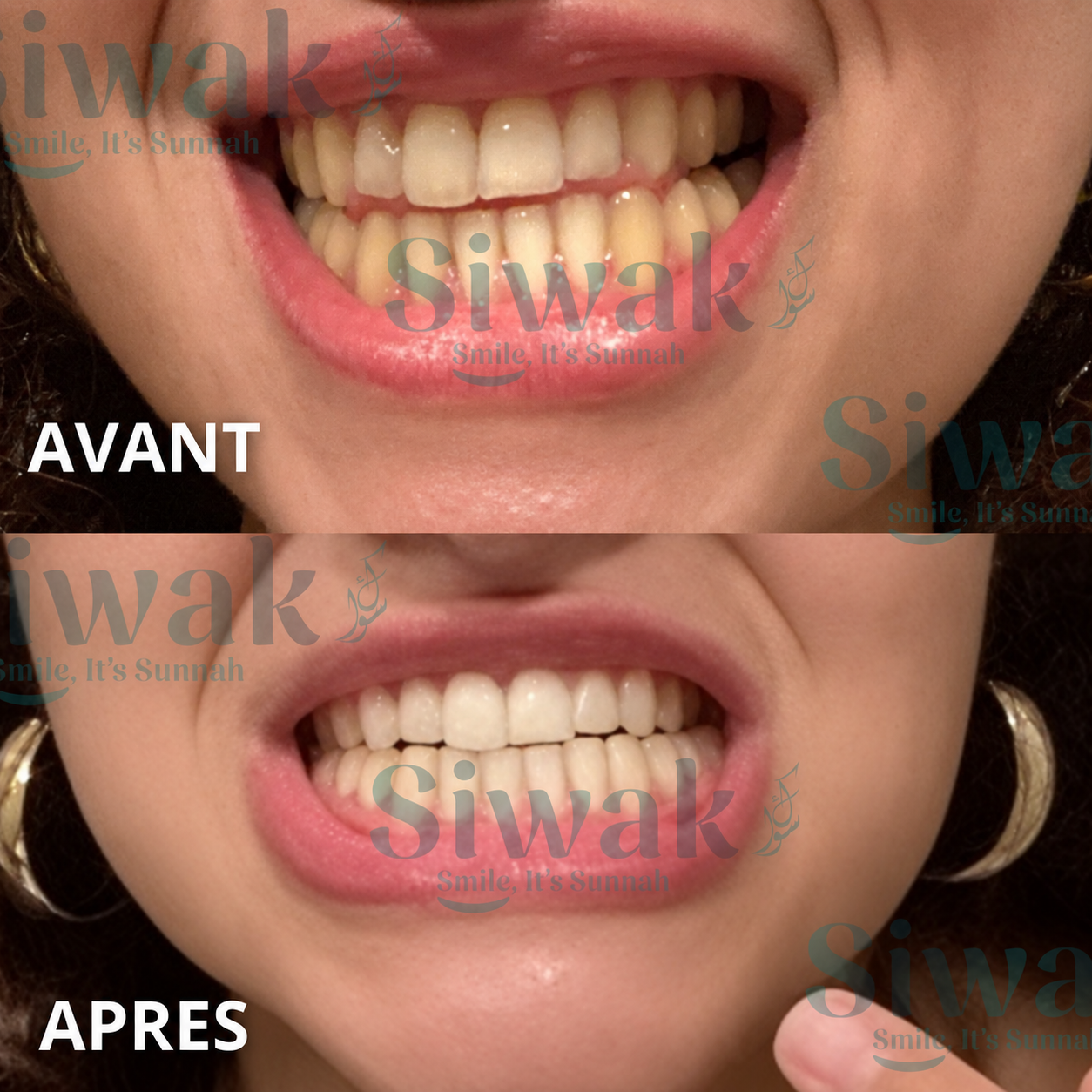 Comparatif avant et après d’une cliente SiwakSmile, avec une colorimétrie harmonisée