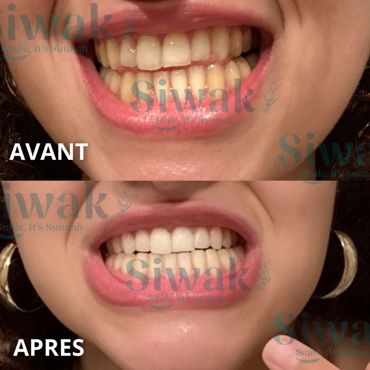 Résultat avant et après le rituel SiwakSmile — femme
