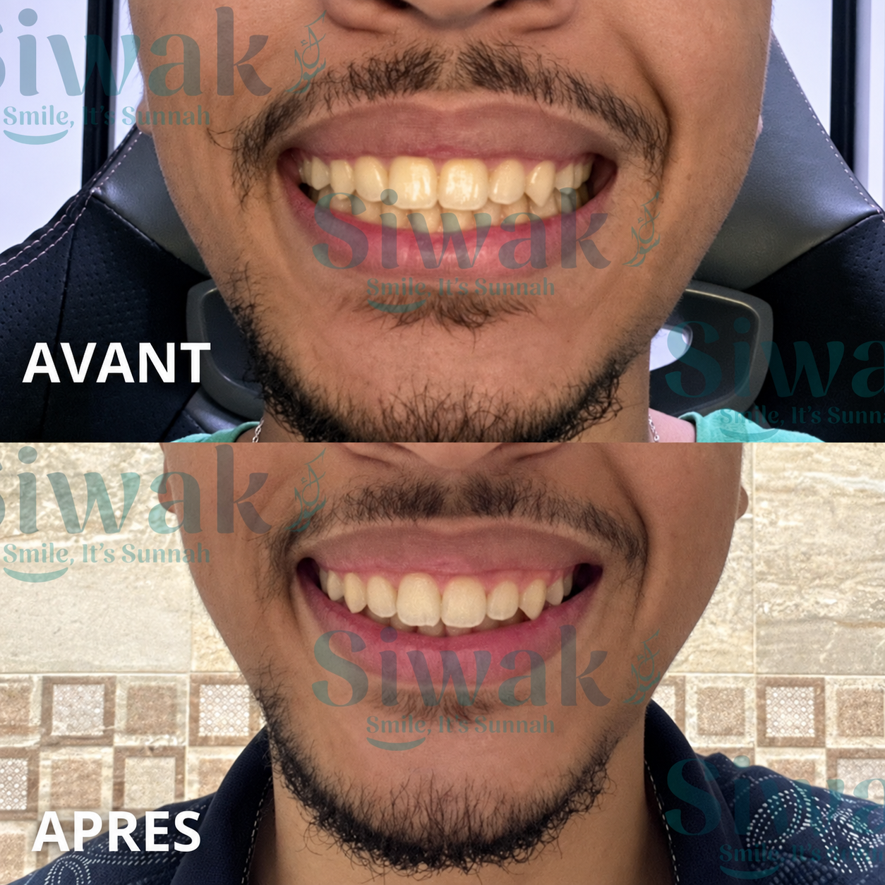 Avant et après en haute définition d’un client après son challenge SiwakSmile