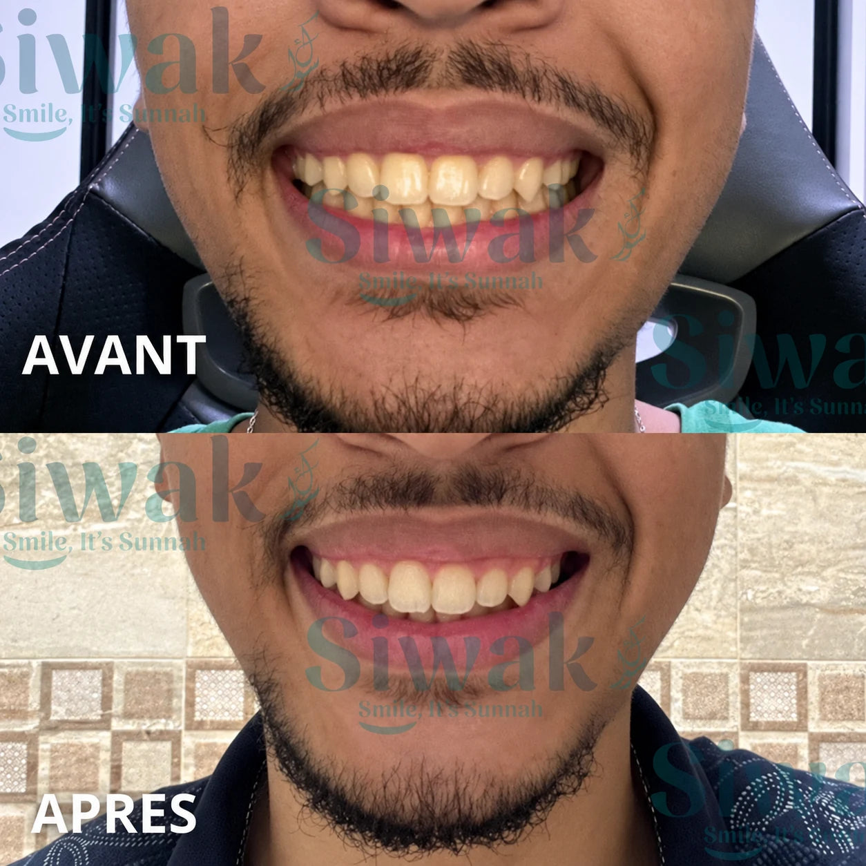 Résultat avant et après le rituel SiwakSmile — homme