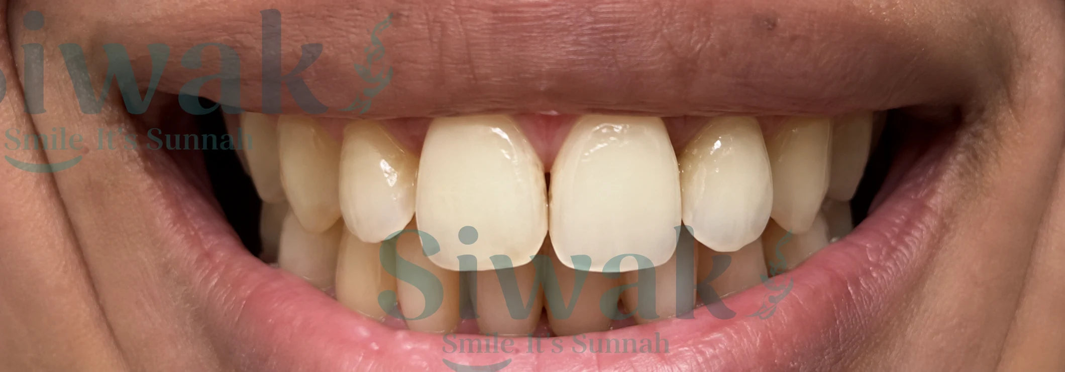 Sourire avant la routine SiwakSmile